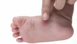 Bolje, da segajo komarji ugrizi pri otrocih